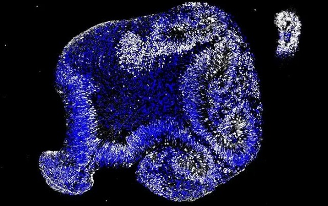Stem Cell Model Points to Alzheimer's Disease Embryonic Origins